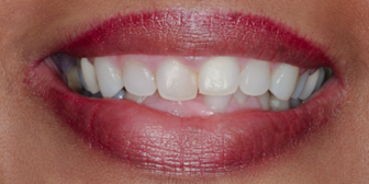 Before Four Upper Veneers Three Lower Veneers, to Lengthen, for Overcrowding