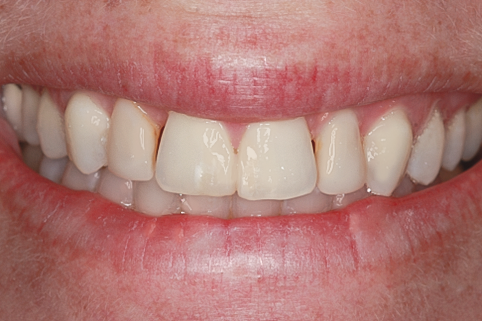Before Four Upper Veneers