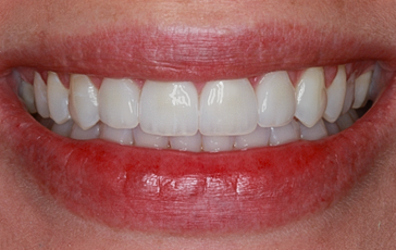 After Four Veneers, to Close Gaps
