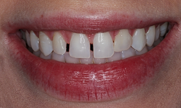 Before Four Veneers, to Close Gaps