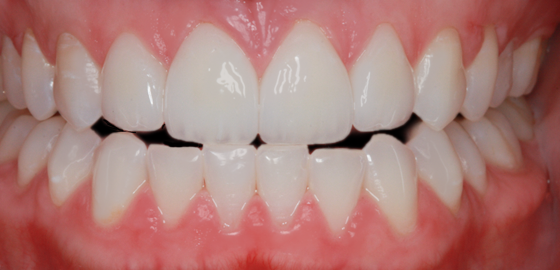 After detail, Four Veneers, to Close Gaps