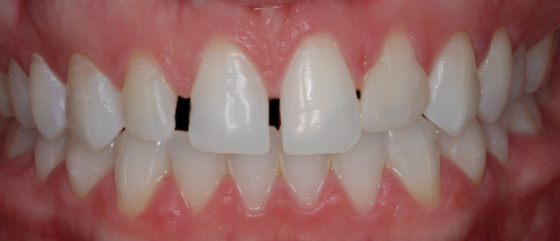 Before detail, Four Veneers, to Close Gaps
