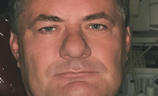 After detail, Full Mouth Reconstruction, 51-YEAR-OLD Businessman