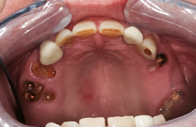 Before detail, Full Mouth Reconstruction, 51-YEAR-OLD Businessman