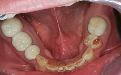 After detail, Full Mouth Reconstruction, 51-YEAR-OLD Businessman
