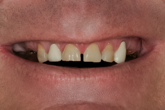Before Full Mouth Reconstruction, 51-YEAR-OLD Businessman
