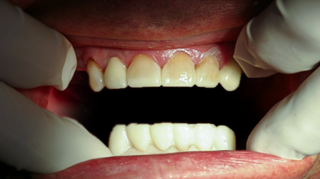 Before detail, Full Mouth Reconstruction, 51-YEAR-OLD Businessman
