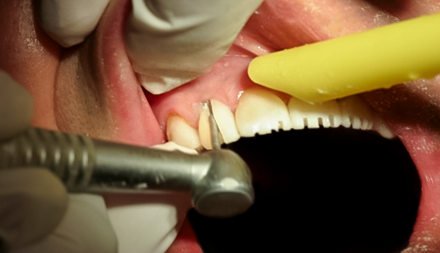 After detail, Full Mouth Reconstruction, 51-YEAR-OLD Businessman