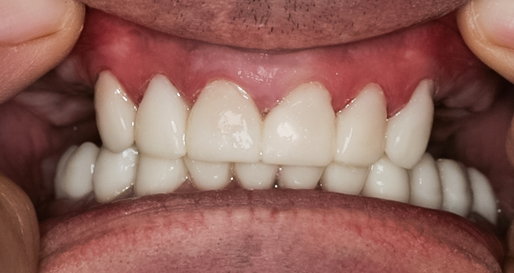PowerPoint case photo, Full Mouth Reconstruction, 51-YEAR-OLD Businessman