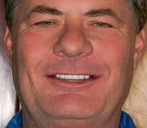 Before detail, Full Mouth Reconstruction, 51-YEAR-OLD Businessman
