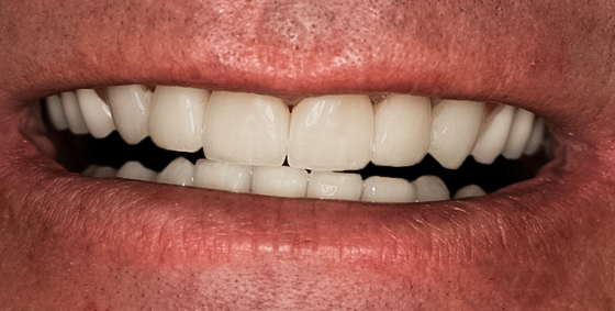 After detail, Full Mouth Reconstruction, 51-YEAR-OLD Businessman