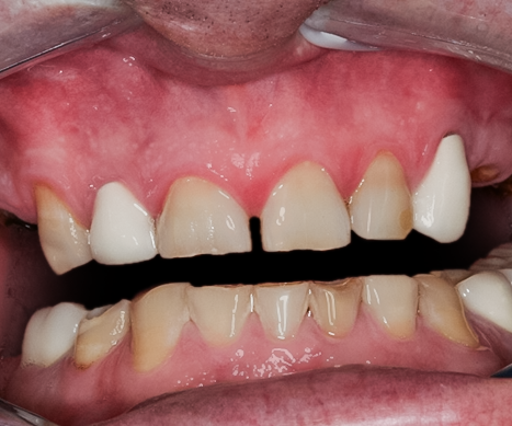 Before detail, Full Mouth Reconstruction, 51-YEAR-OLD Businessman