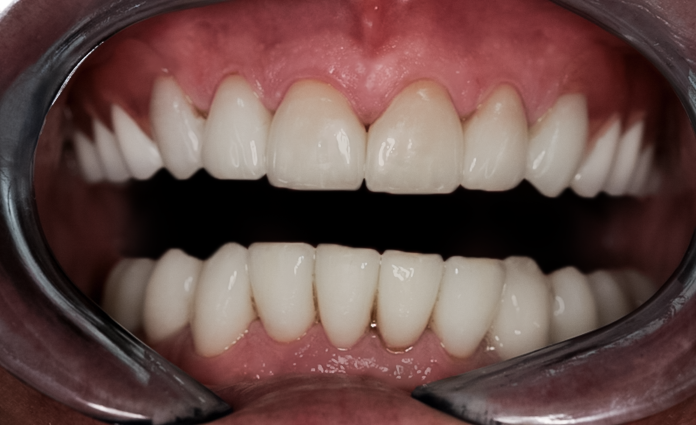 Before detail, Full Mouth Reconstruction, 51-YEAR-OLD Businessman