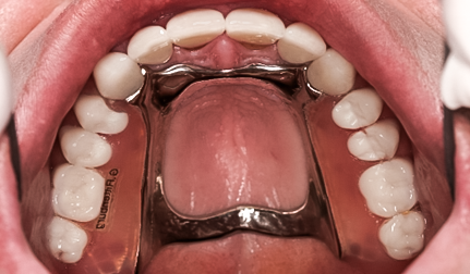 Before detail, Full Mouth Reconstruction, 51-YEAR-OLD Businessman