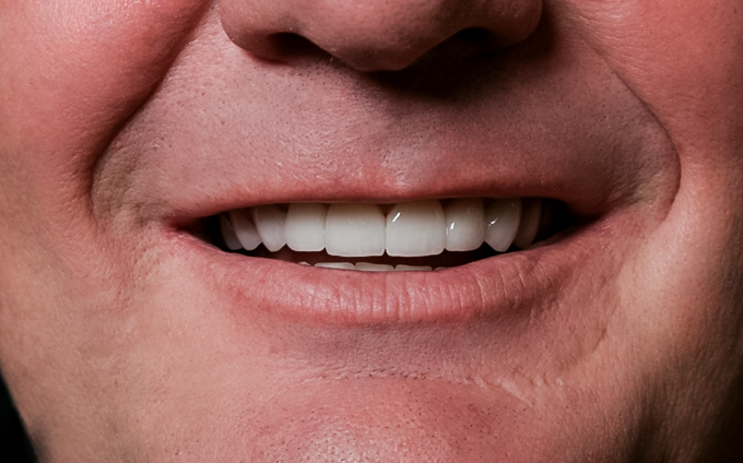 After Full Mouth Reconstruction, 51-YEAR-OLD Businessman