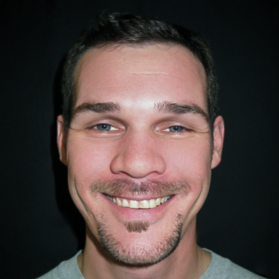 Before Full Mouth Rehabilitation, Greg