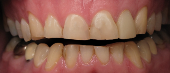 Before detail, Full Mouth Rehabilitation, Greg