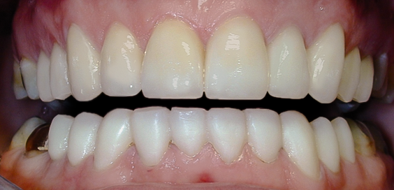 After detail, Full Mouth Rehabilitation, Greg