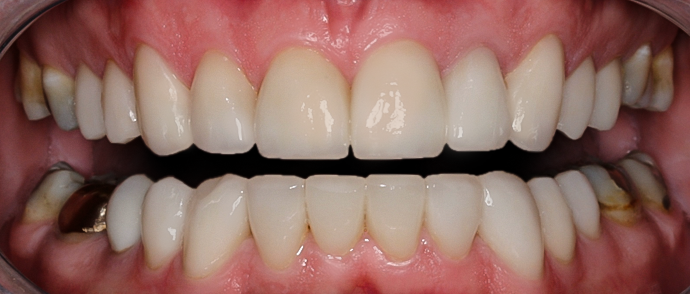 Before detail, Full Mouth Rehabilitation, Greg