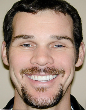 After Full Mouth Rehabilitation, Greg