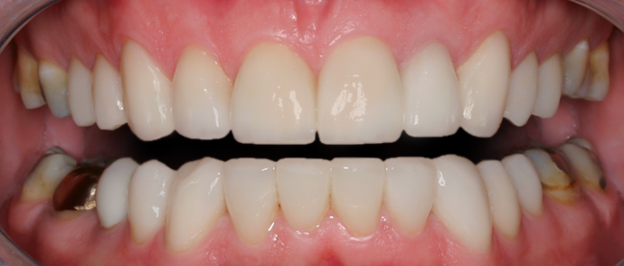 After detail, Full Mouth Rehabilitation, Greg