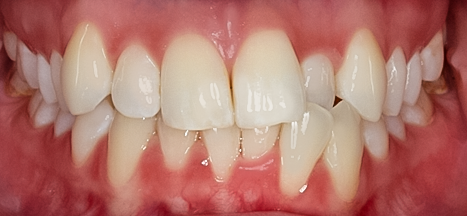 Before Invisalign®, Kara
