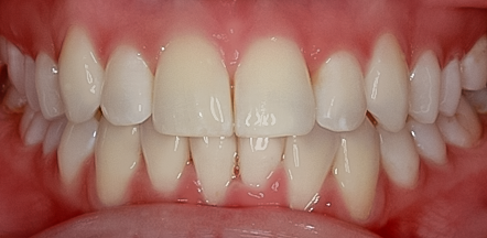 Invisalign®, Kara