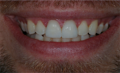 After detail, Two Veneers & Crown, Jason