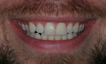 Before detail, Two Veneers & Crown, Jason