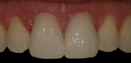 After Two Veneers & Crown, Jason