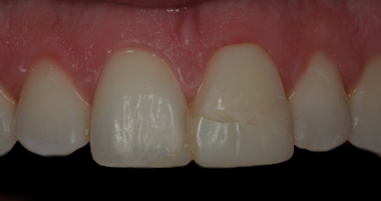 Before Two Veneers & Crown, Jason