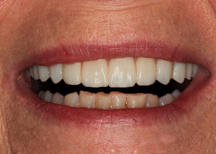 After Veneers & Crowns, Jenny
