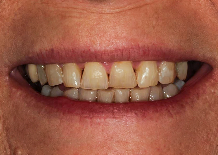 Before Veneers & Crowns, Jenny