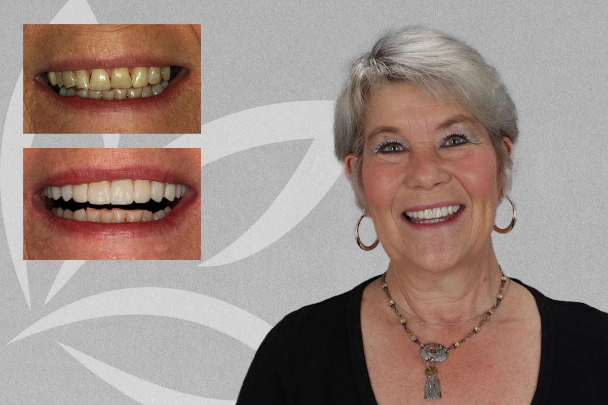 Veneers & Crowns, Jenny featured transformation