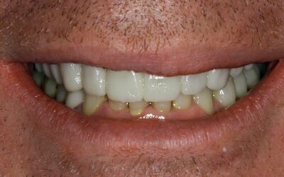 After John’s Complete Smile Transformation
