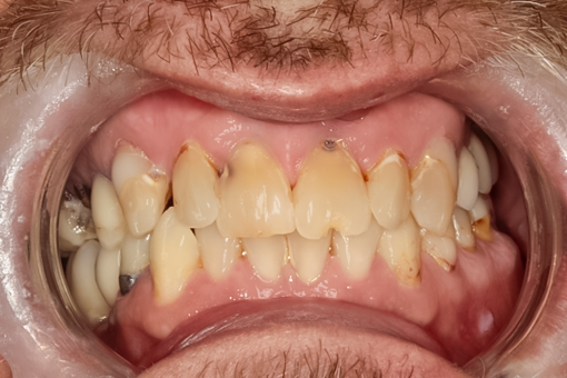 Before Implant Supported Upper and Lower Denture, Josh
