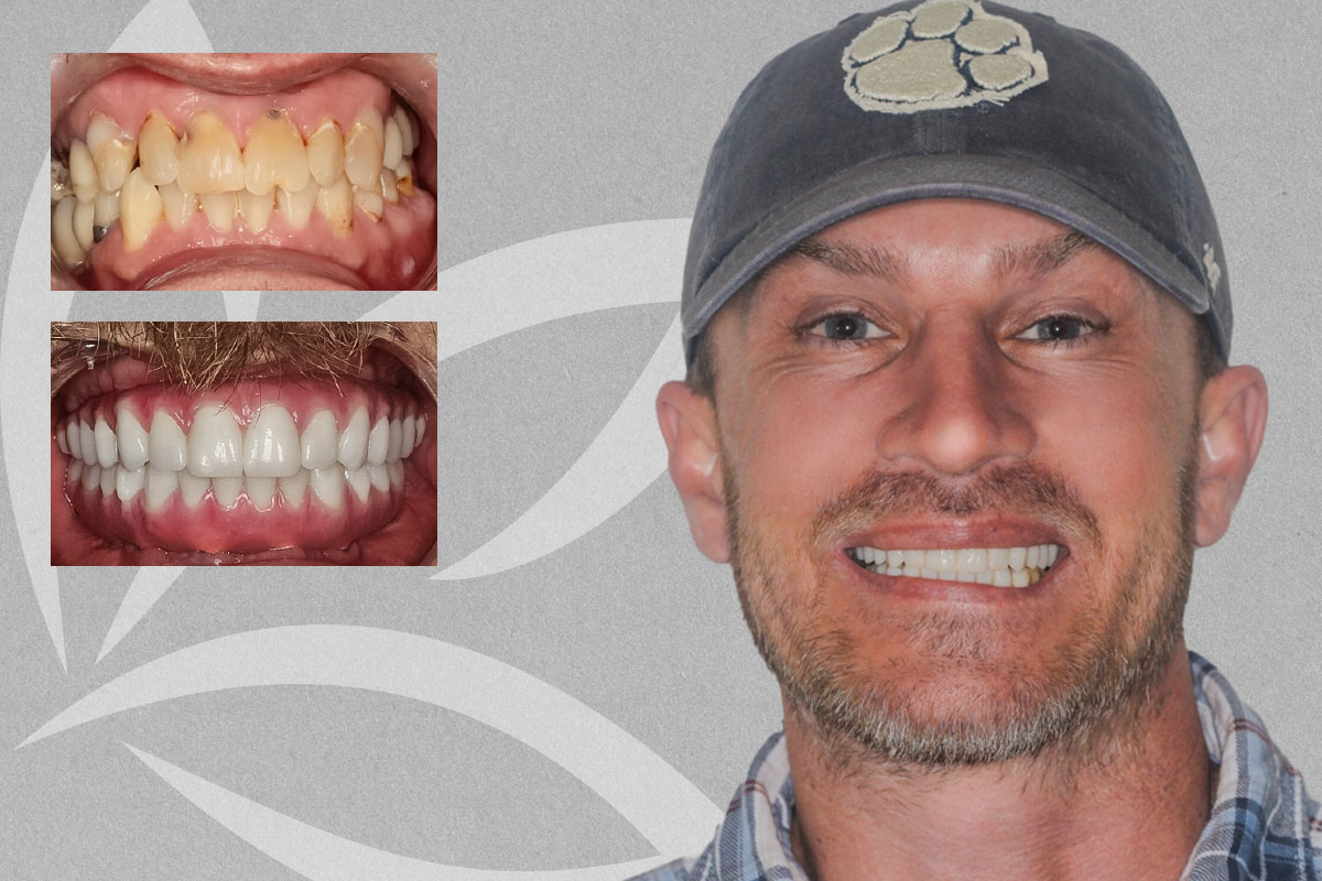 Implant Supported Upper and Lower Denture, Josh