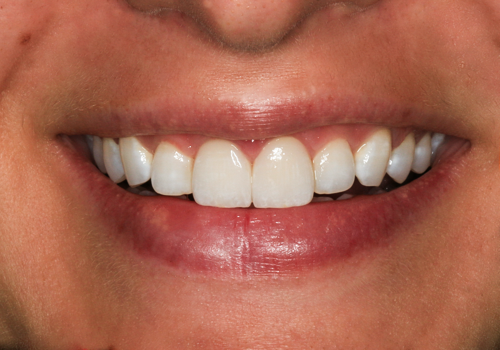 After Veneers, Crowns & Zoom! Whitening, Kaitlyn