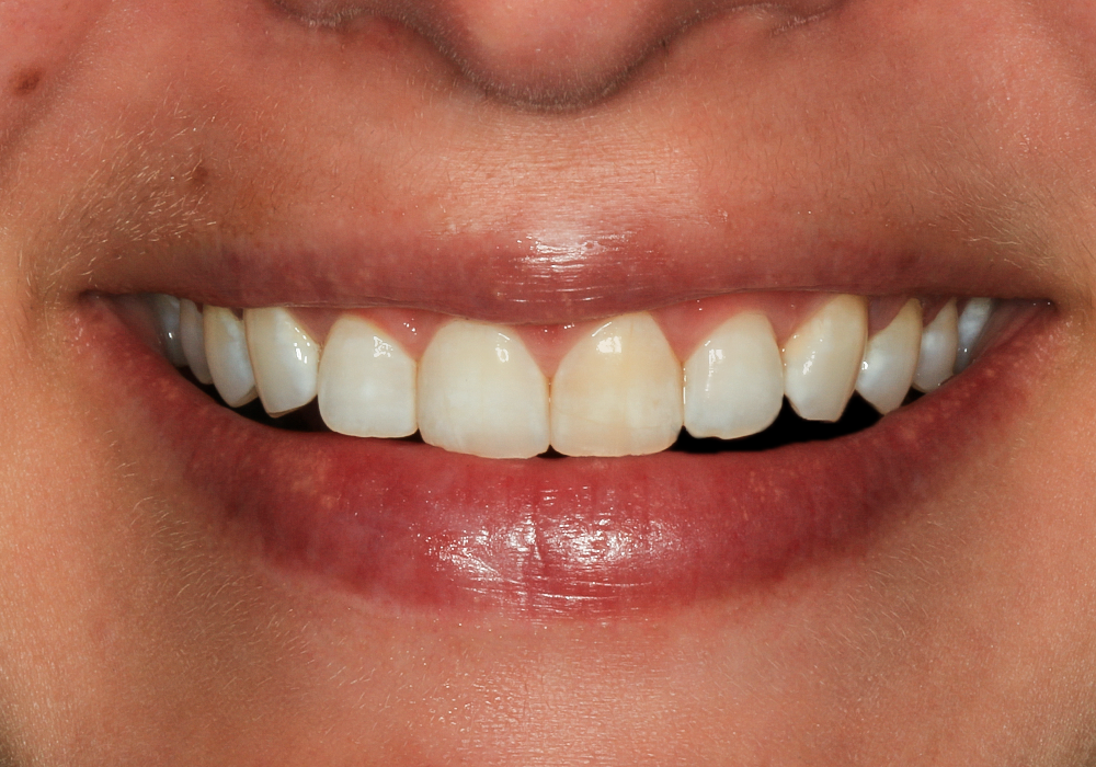 Before Veneers, Crowns & Zoom! Whitening, Kaitlyn