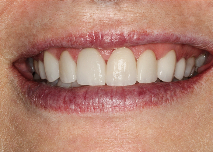 After Veneers & Crowns, Laurie