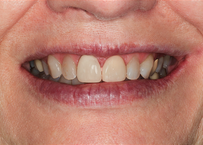 Before Veneers & Crowns, Laurie