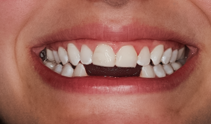 Before Lower Anterior Implant Bridge