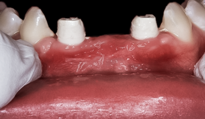 Before detail, Lower Anterior Implant Bridge