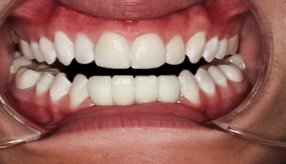 After Lower Anterior Implant Bridge
