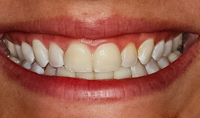 After detail, Lower Anterior Implant Bridge