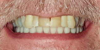 After Lower Implant Hybrid Denture