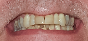 Before Lower Implant Hybrid Denture