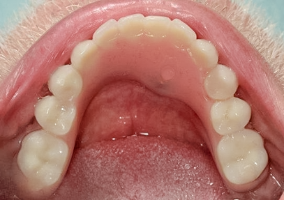 After detail, Lower Implant Hybrid Denture