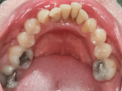 Before detail, Lower Implant Hybrid Denture