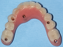 After detail, Lower Implant Hybrid Denture